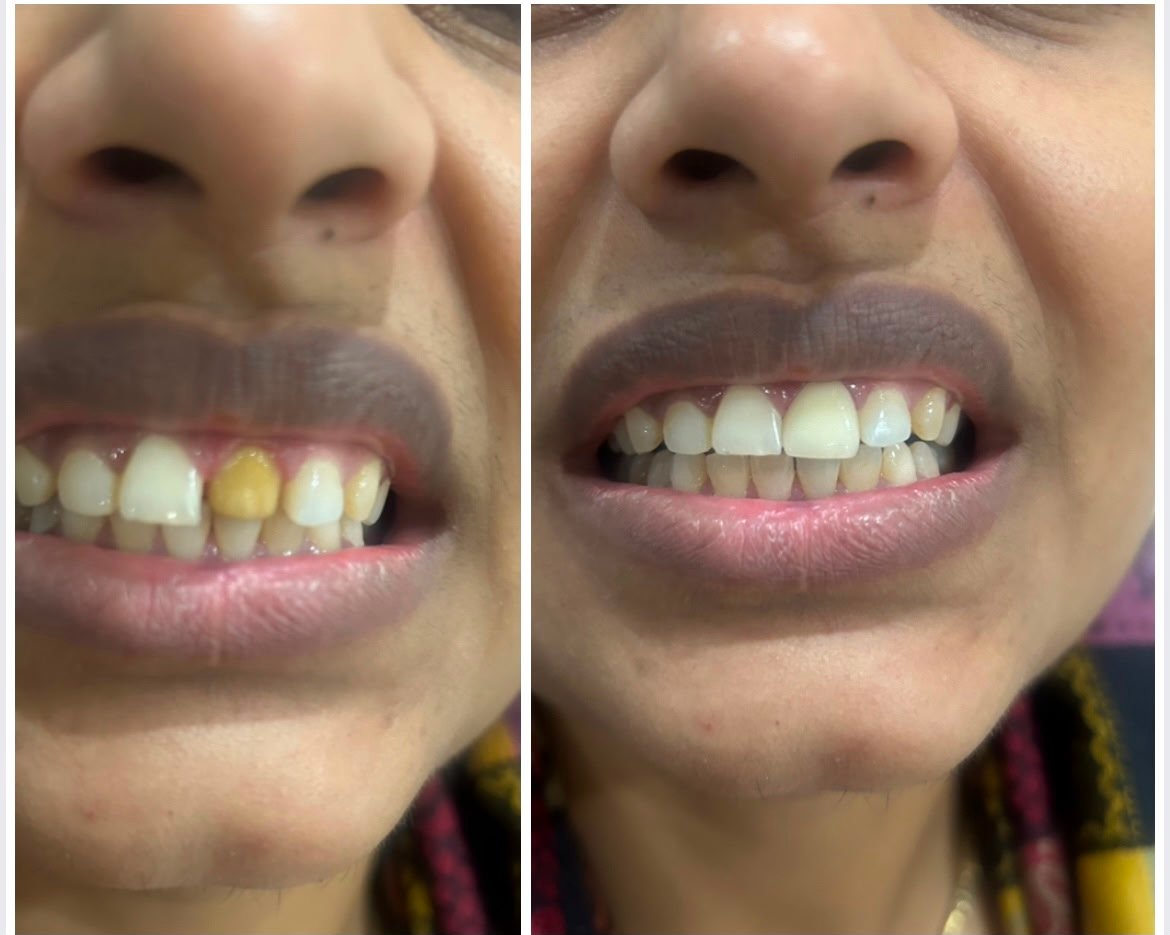 Before and after dental smile treatment result