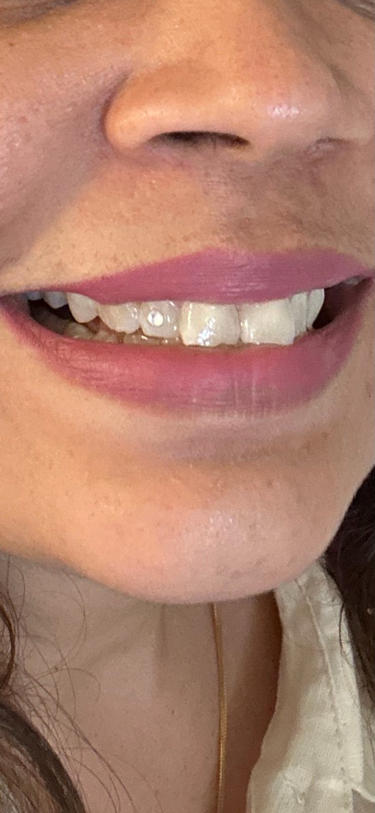 Close-up of patient smile