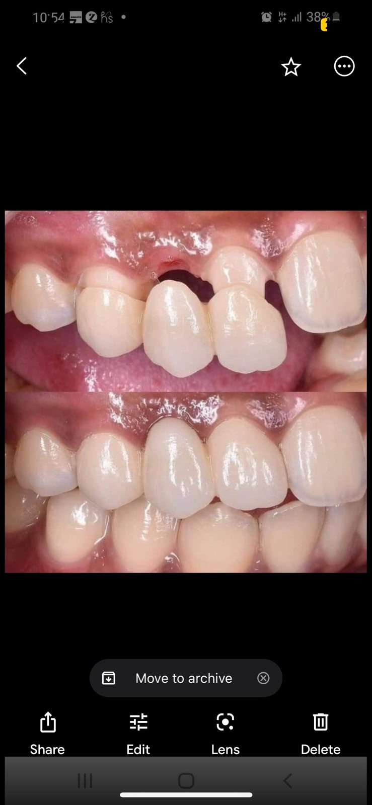 Before and after tooth restoration close-up